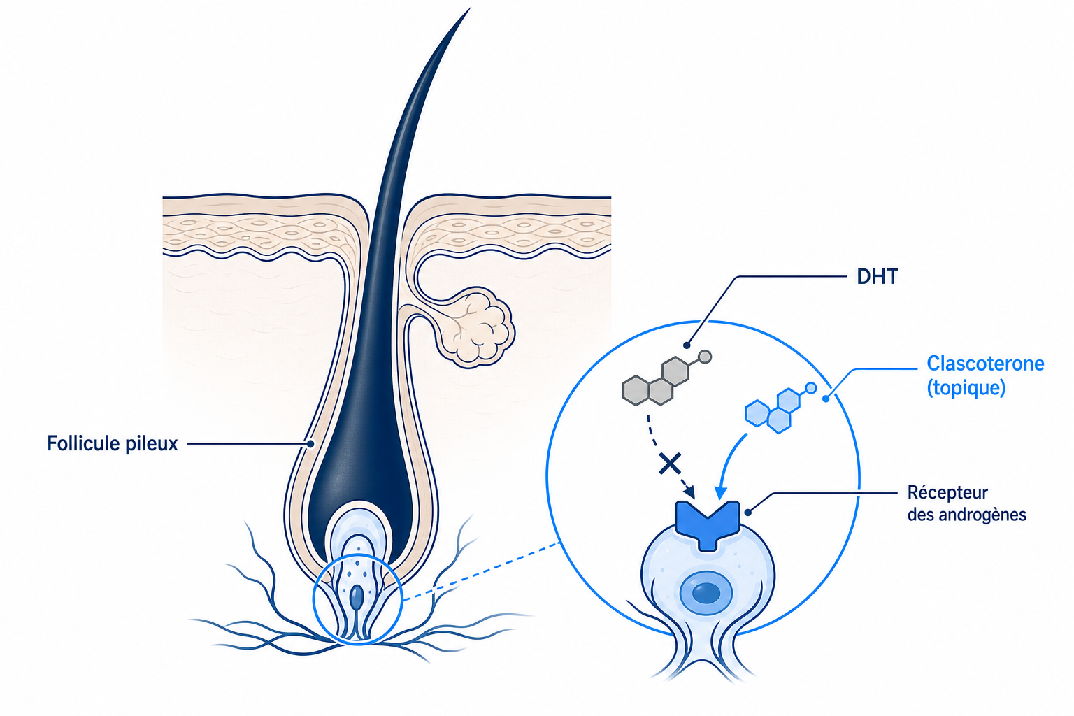 Illustration&nbsp;: le clascoterone bloque le récepteur des androgènes au niveau du follicule pileux et évince la DHT