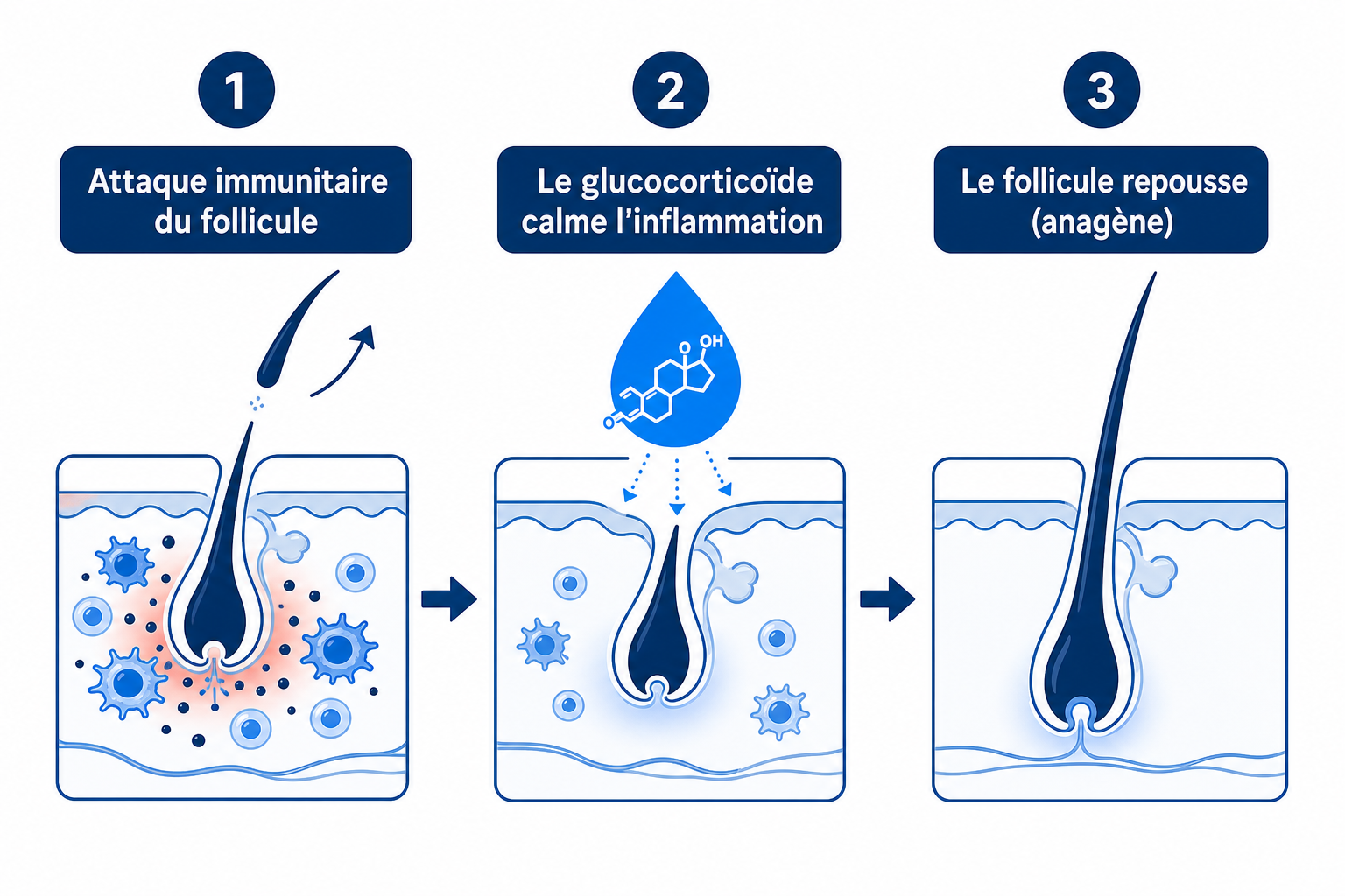 Infographie : comment les glucocorticoïdes calment l'attaque immunitaire du follicule pileux et permettent la repousse