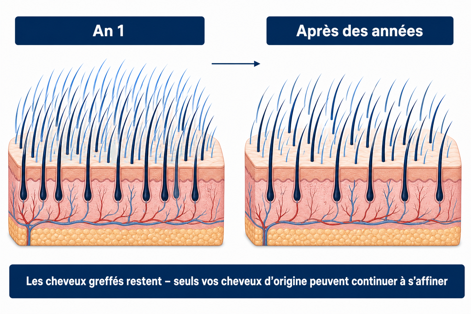 Les cheveux greffés restent durablement, seuls les cheveux d'origine entre eux peuvent continuer à se raréfier au fil des années
