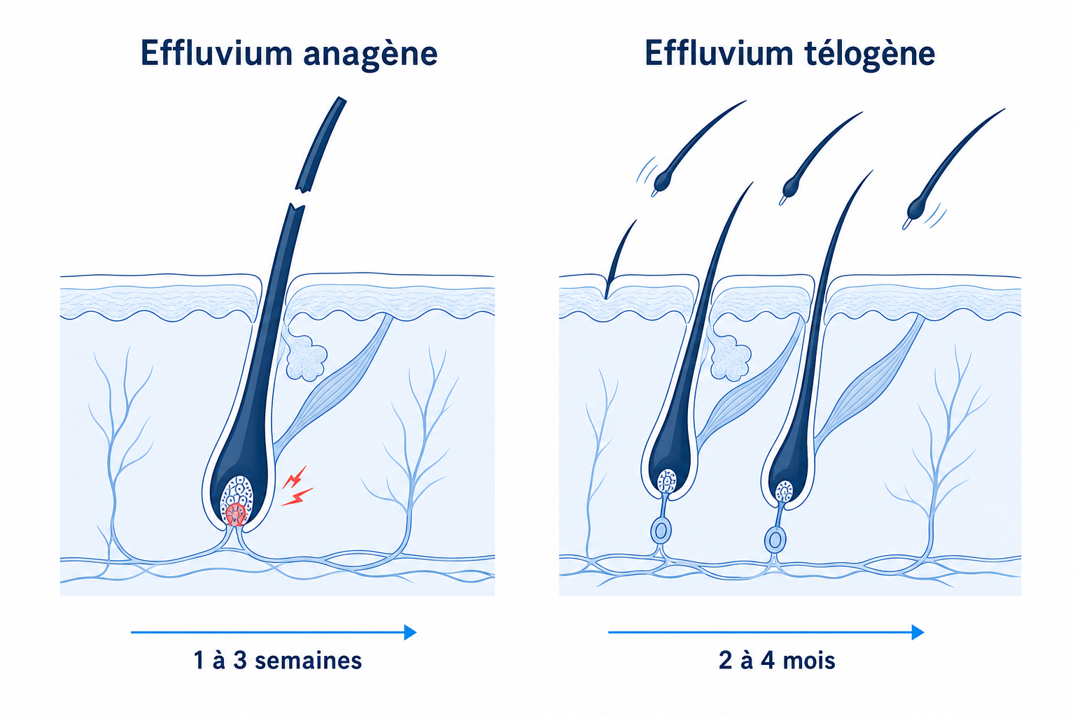 Comparaison de l'effluvium anagène et télogène : cassure du cheveu en phase de croissance après 1 à 3 semaines contre chute diffuse en phase de repos après 2 à 4 mois