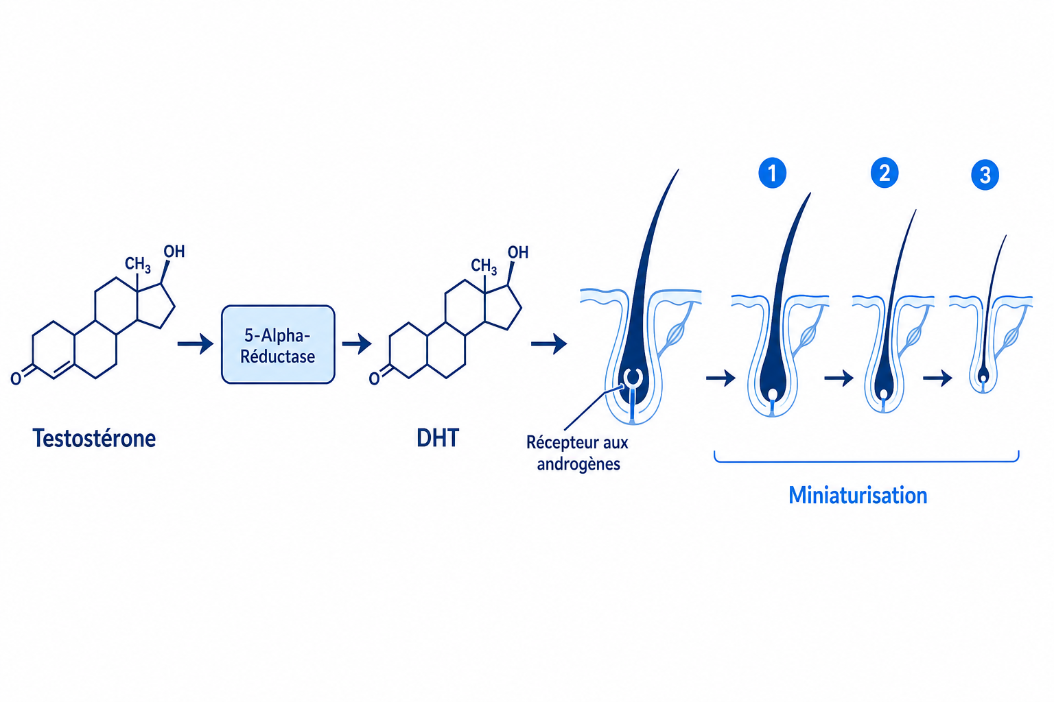 Schéma de la chaîne d'action de la DHT : testostérone, 5-alpha-réductase, DHT et miniaturisation du follicule des tempes
