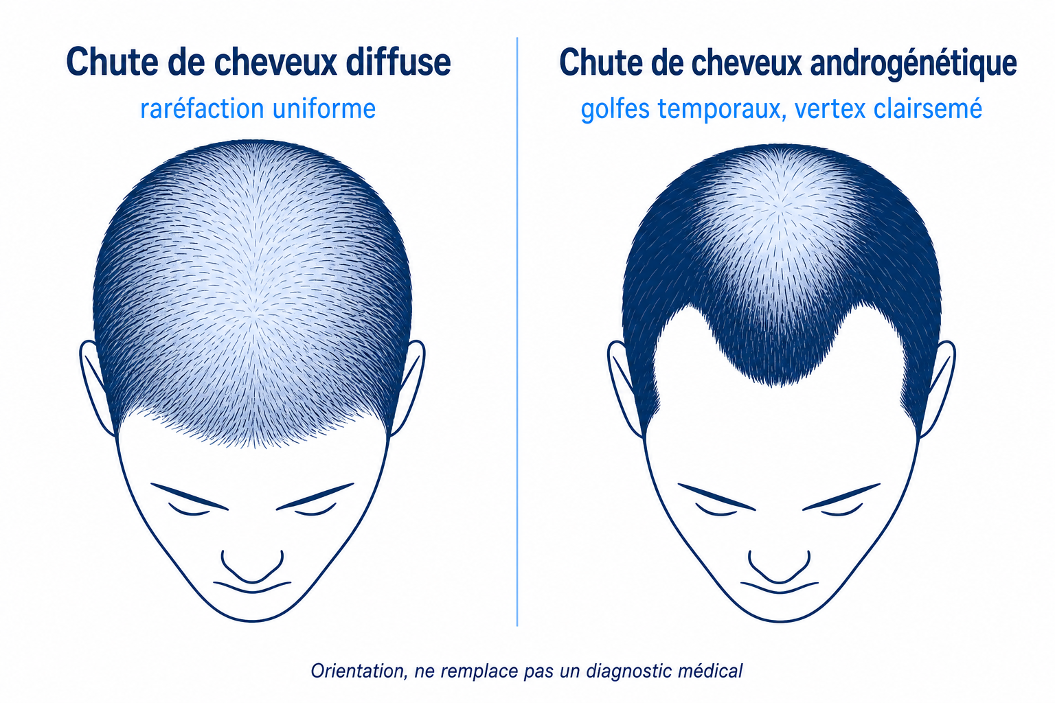 Diagramme comparatif chute de cheveux diffuse versus androgénétique, deux silhouettes de tête avec motif de raréfaction