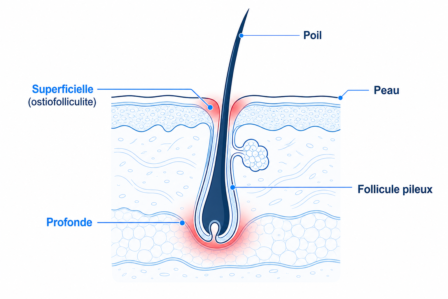 Coupe transversale d'un follicule pileux avec zone d'inflammation superficielle et profonde