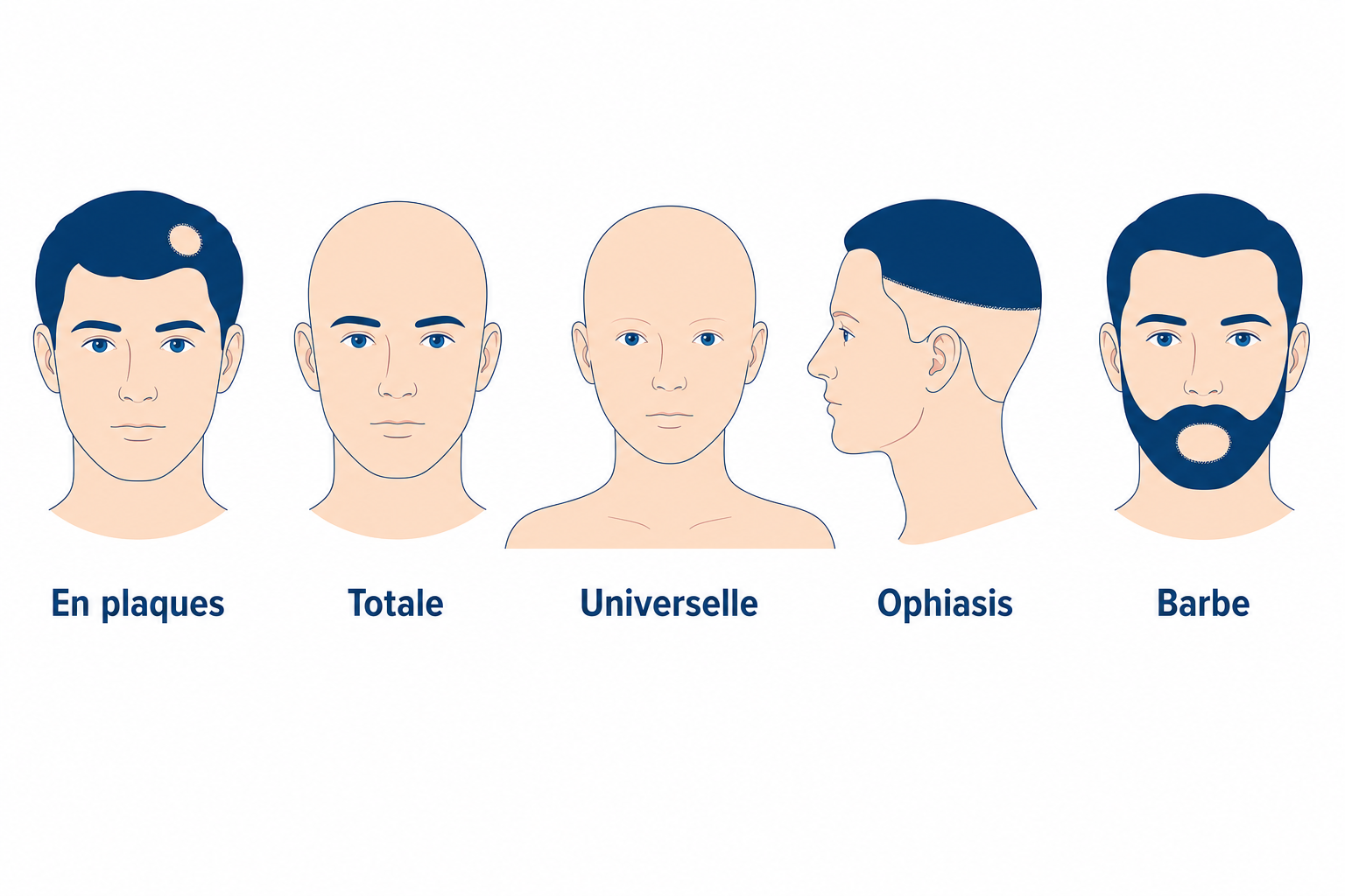 Formes de la pelade : en plaques, totale, universelle, ophiasis et de la barbe