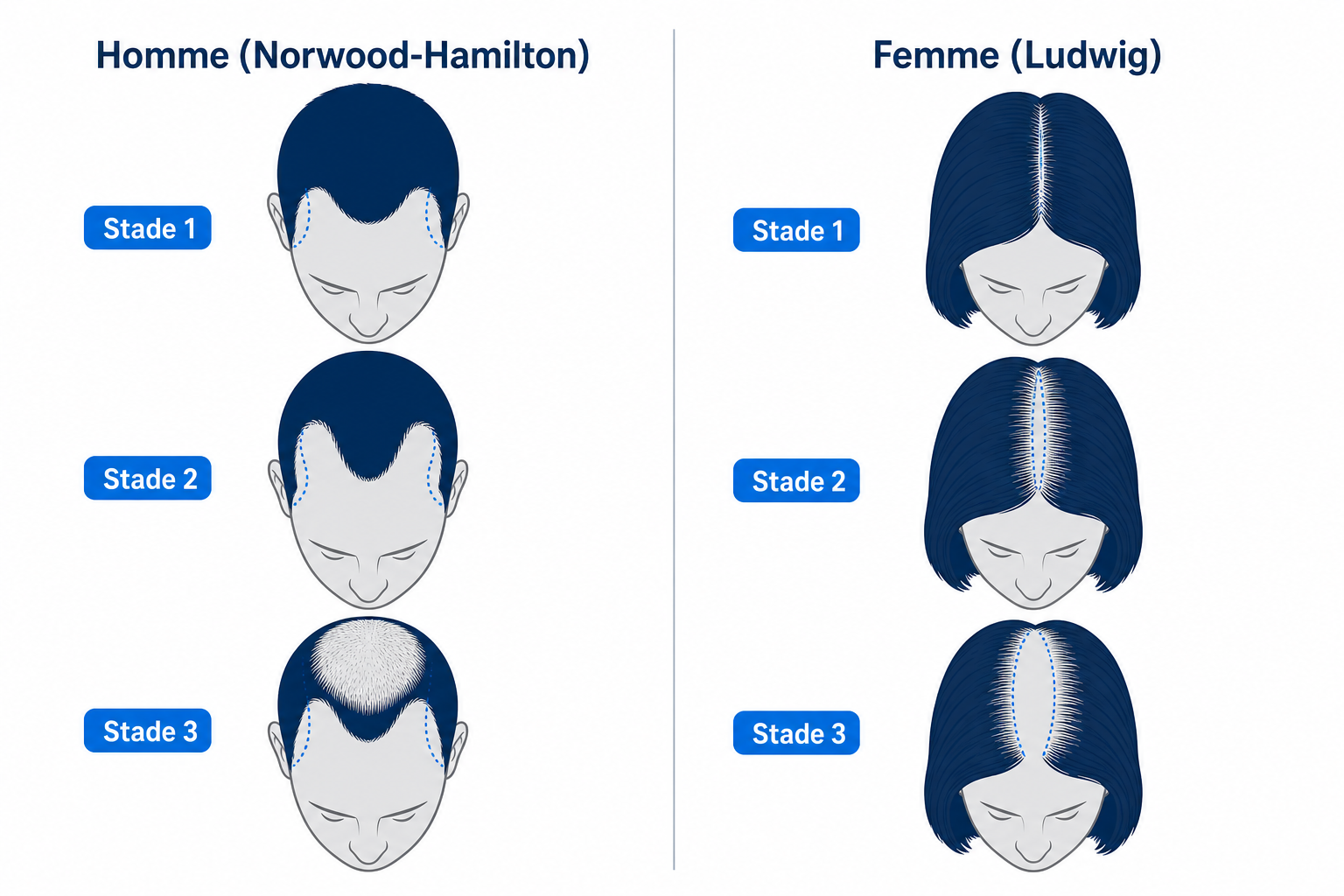 Comparaison schématique des schémas de chute de cheveux chez l'homme (Norwood-Hamilton) et chez la femme (Ludwig) dans l'alopécie androgénétique
