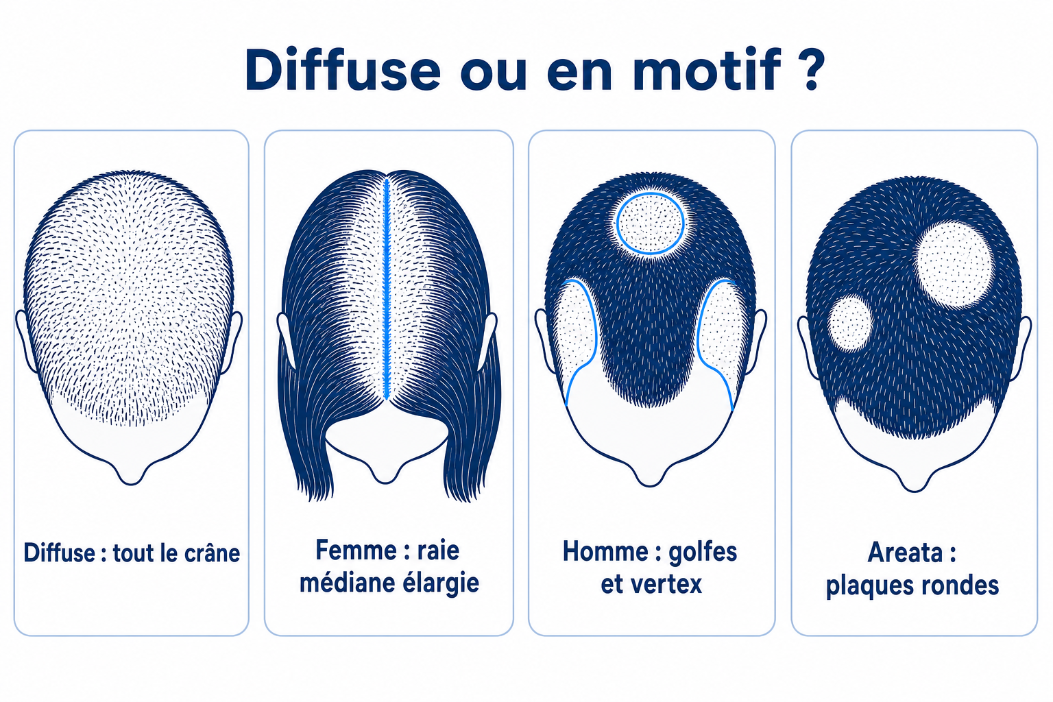 Comparaison de quatre motifs de chute de cheveux : éclaircissement diffus sur tout le crâne, raie médiane élargie chez la femme, golfes temporaux et vertex chez l’homme, plaques rondes glabres en cas d’alopecia areata