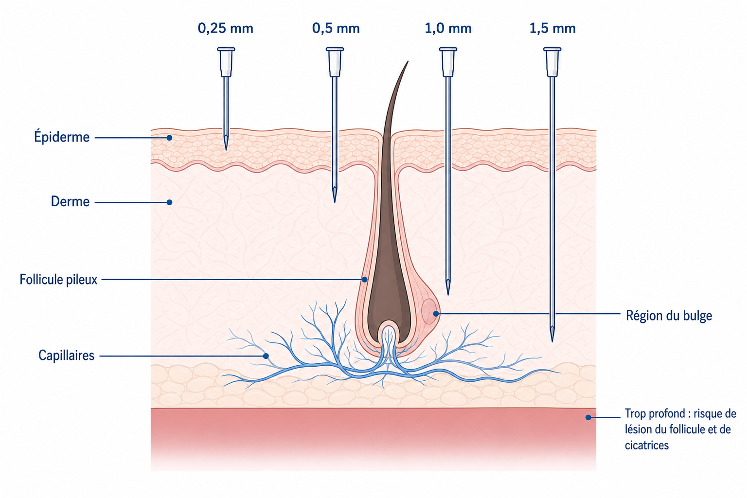 Coupe transversale du cuir chevelu avec des longueurs d’aiguille de 0,25 à 1,5 mm et la zone à risque de lésion du follicule