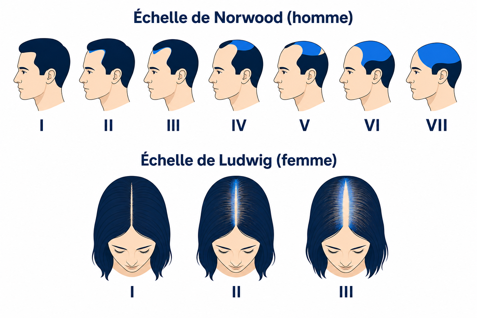 Échelle de Norwood pour les hommes et échelle de Ludwig pour les femmes pour classer la chute de type androgénétique