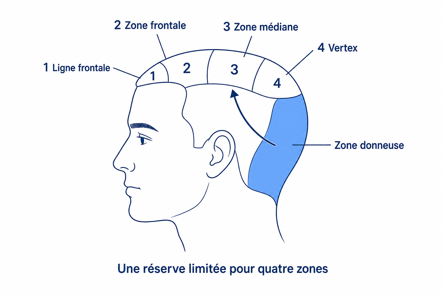 Schéma : la zone donneuse limitée à l'arrière de la tête alimente quatre zones receveuses numérotées, de la ligne frontale au vertex