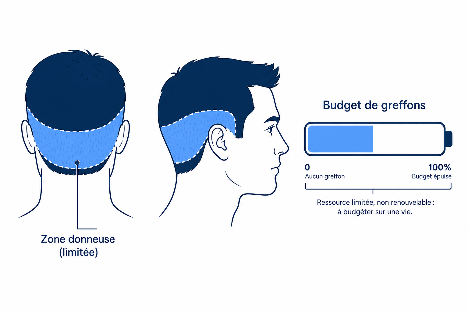 Schéma de la zone donneuse limitée à l'arrière de la tête, présentée comme budget de greffons pour la vie