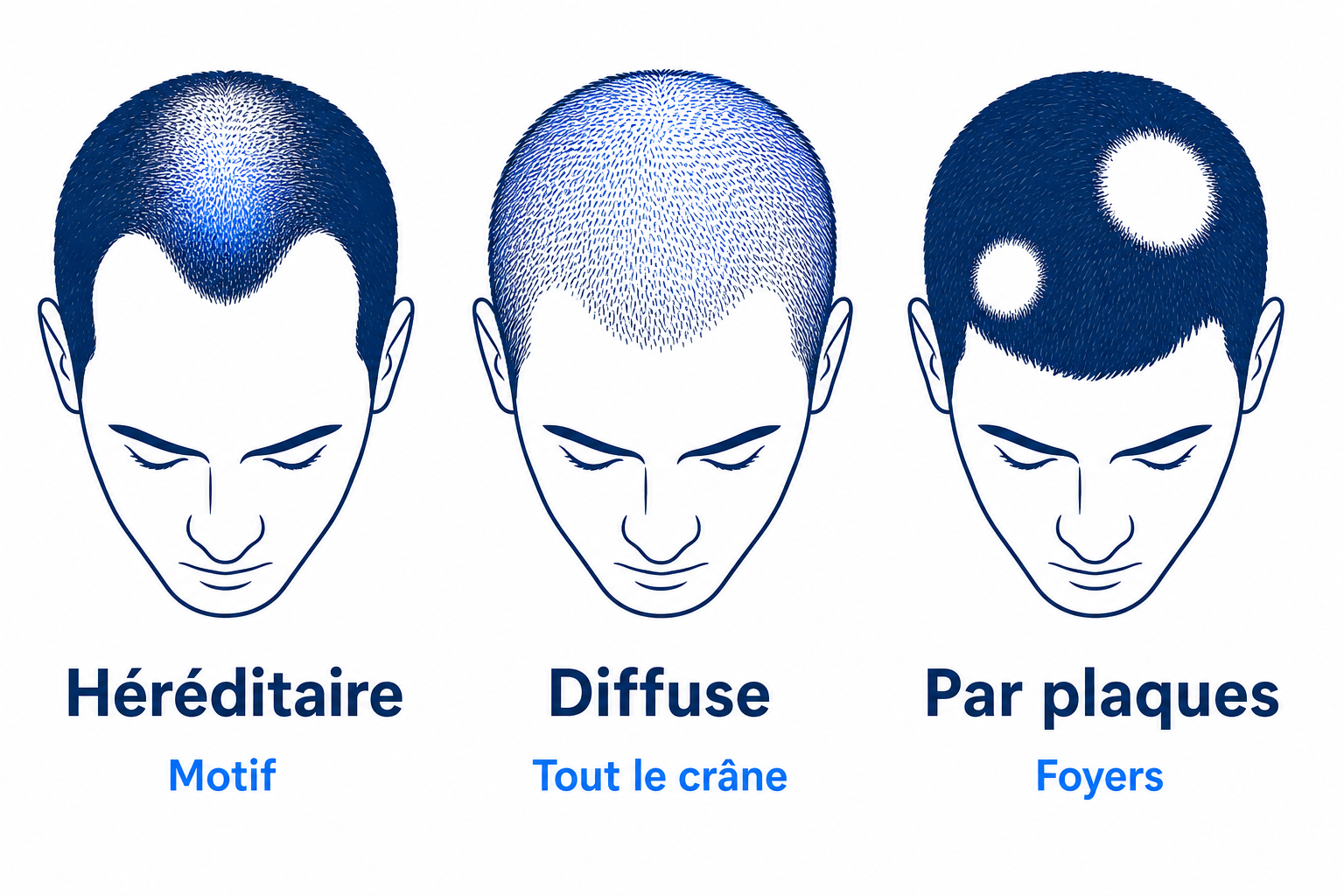 Infographie des trois types de chute de cheveux : héréditaire, diffuse et par plaques