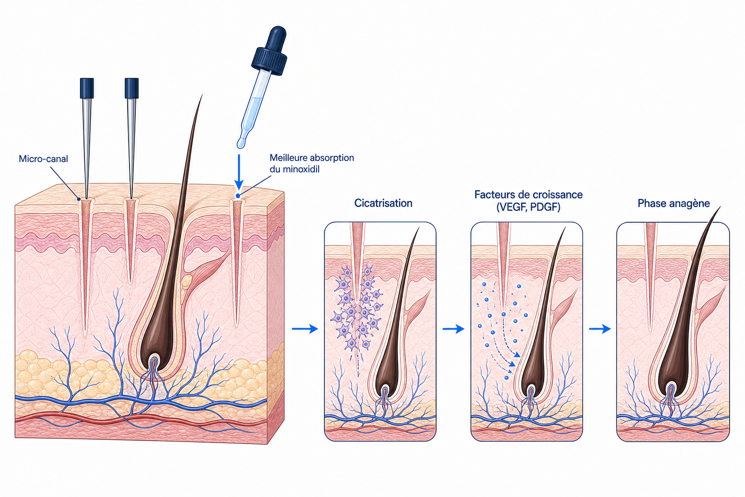 Illustration du mécanisme d’action du microneedling sur le cuir chevelu : micro-canal, cicatrisation, facteurs de croissance et phase anagène