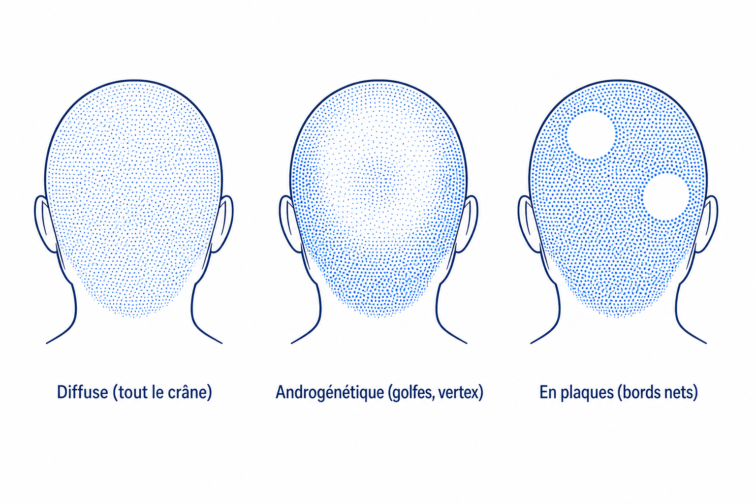 Comparaison des trois motifs de chute : diffus, androgénétique et en plaques, illustrés par des silhouettes de crâne
