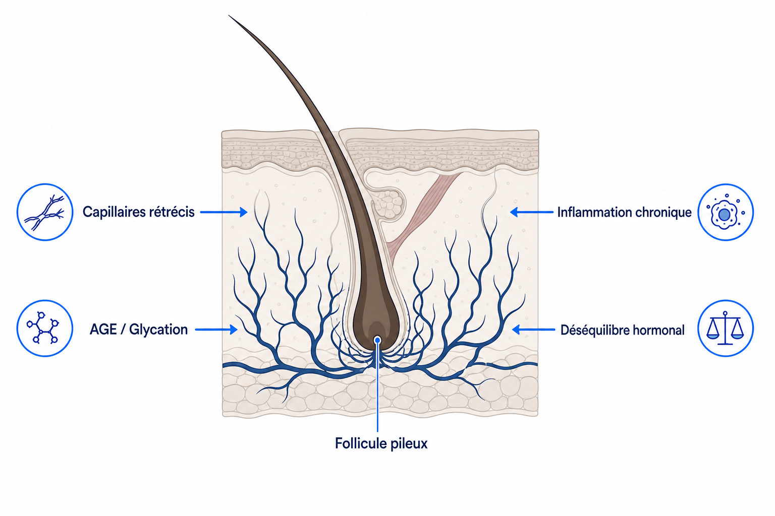 Illustration d'un follicule pileux en coupe cutanée avec les quatre mécanismes par lesquels le diabète perturbe la pousse des cheveux