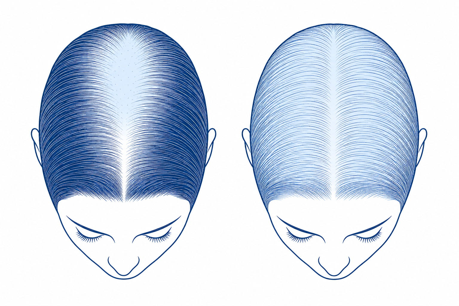Comparaison schématique vue de dessus : à gauche la raie médiane qui s'élargit dans l'alopécie androgénétique féminine, à droite la raréfaction homogène de la chute diffuse