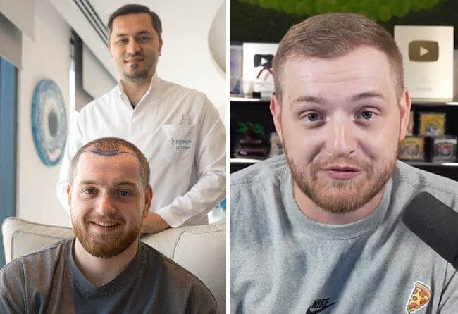 Trapianto di capelli di Trymacs presso Elithair
