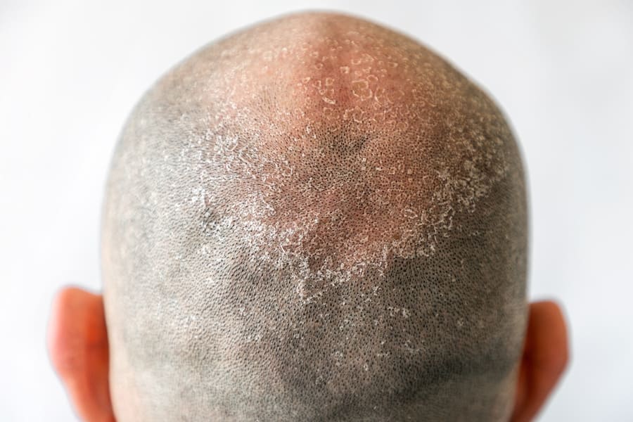 particolare della testa di un uomo che soffre di psoriasi del cuoio capelluto