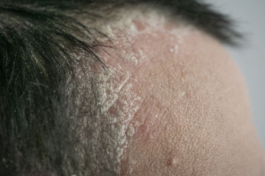 foto della testa di un uomo che soffre di psoriasi al cuoio capelluto