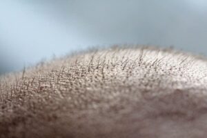 la crescita dei capelli trapiantati varia da paziente a paziente.
