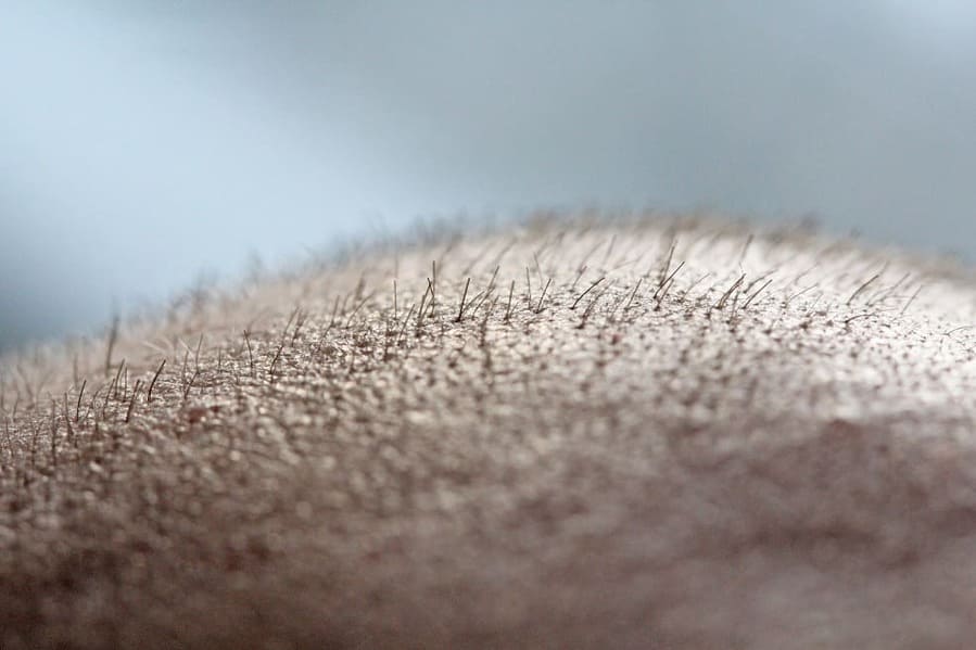 la crescita dei capelli trapiantati varia da paziente a paziente.