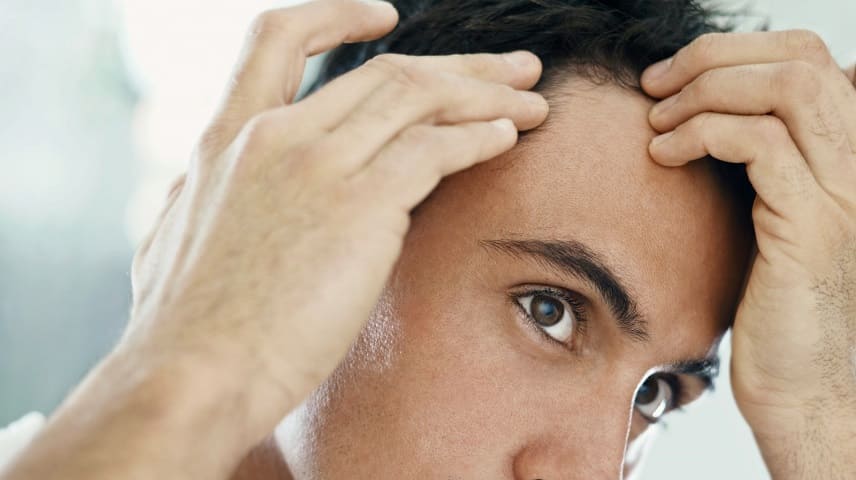 ragazzo stempiato a 20 anni