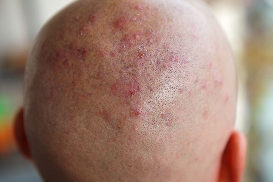 i brufoli post trapianto di capelli possono apparire sia nella zona donatrice sia nella ricevente