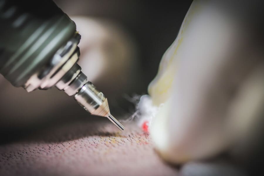 il trapianto di barba ha dei tempi di recupero che vanno da 10 a 15 giorni