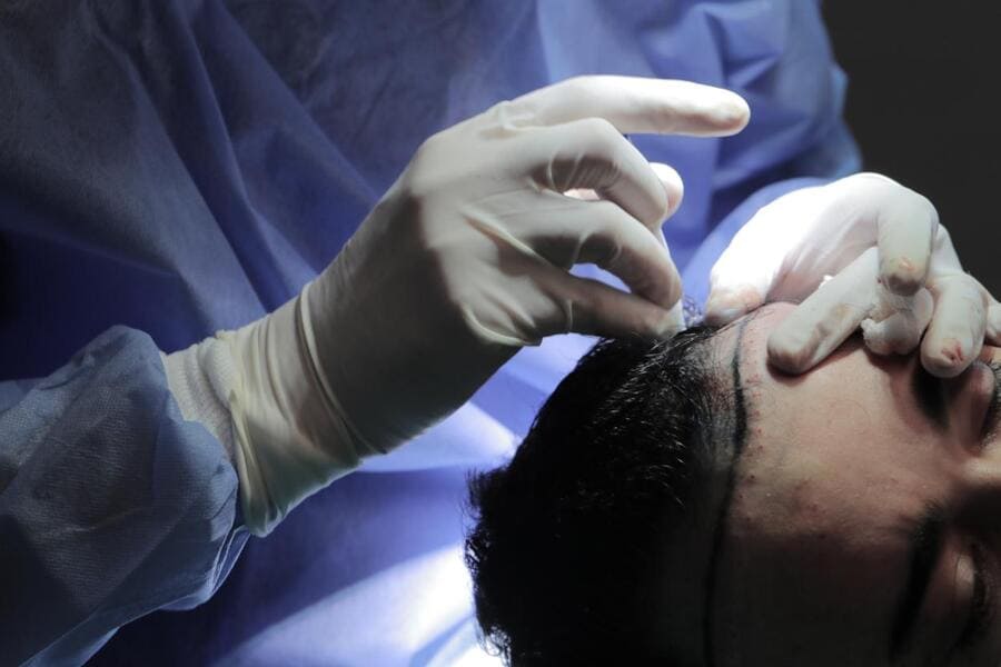 un paziente mentre effettua un trapianto di capelli senza rasatura
