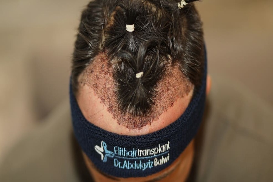 paziente che ha effettuato un trapianto di capelli con rasatura parziale