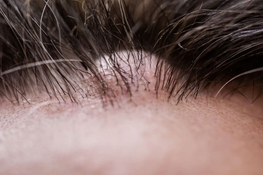 cuoio capelluto di un paziente affetto da alopecia cicatriziale