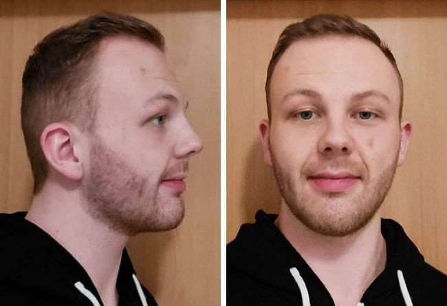 foto del prima e dopo il trapianto di barba zaffiro da 3250 innesti fatto da sascha lockermann quando è passato 1 mese