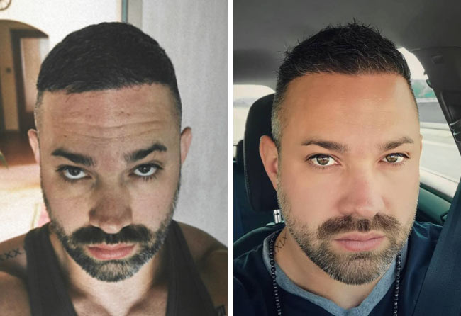 risultato dopo 6 mesi dal trapianto di capelli da 3700 innesti di Manuel Anderhuber