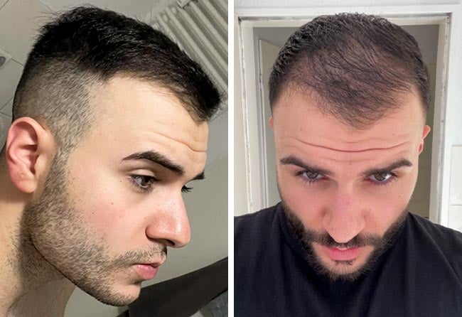 Risultato dopo 3 mesi dal trapianto di capelli DHI da 4700 innesti di Okan Yueksel