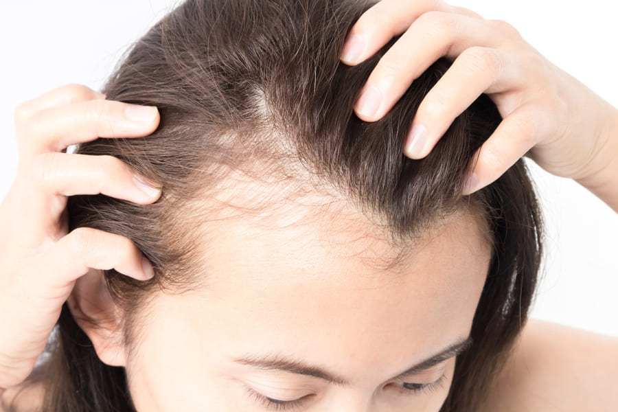 foto di una donna che soffre di perdita di capelli