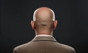 uomo calvo che si domanda come si possono recuperare i capelli persi