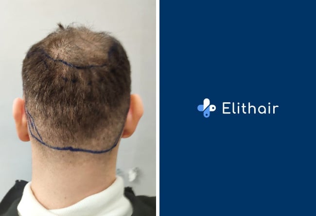 Foto prima e dopo del trapianto di capelli di Kerim Engizek con zona donatrice