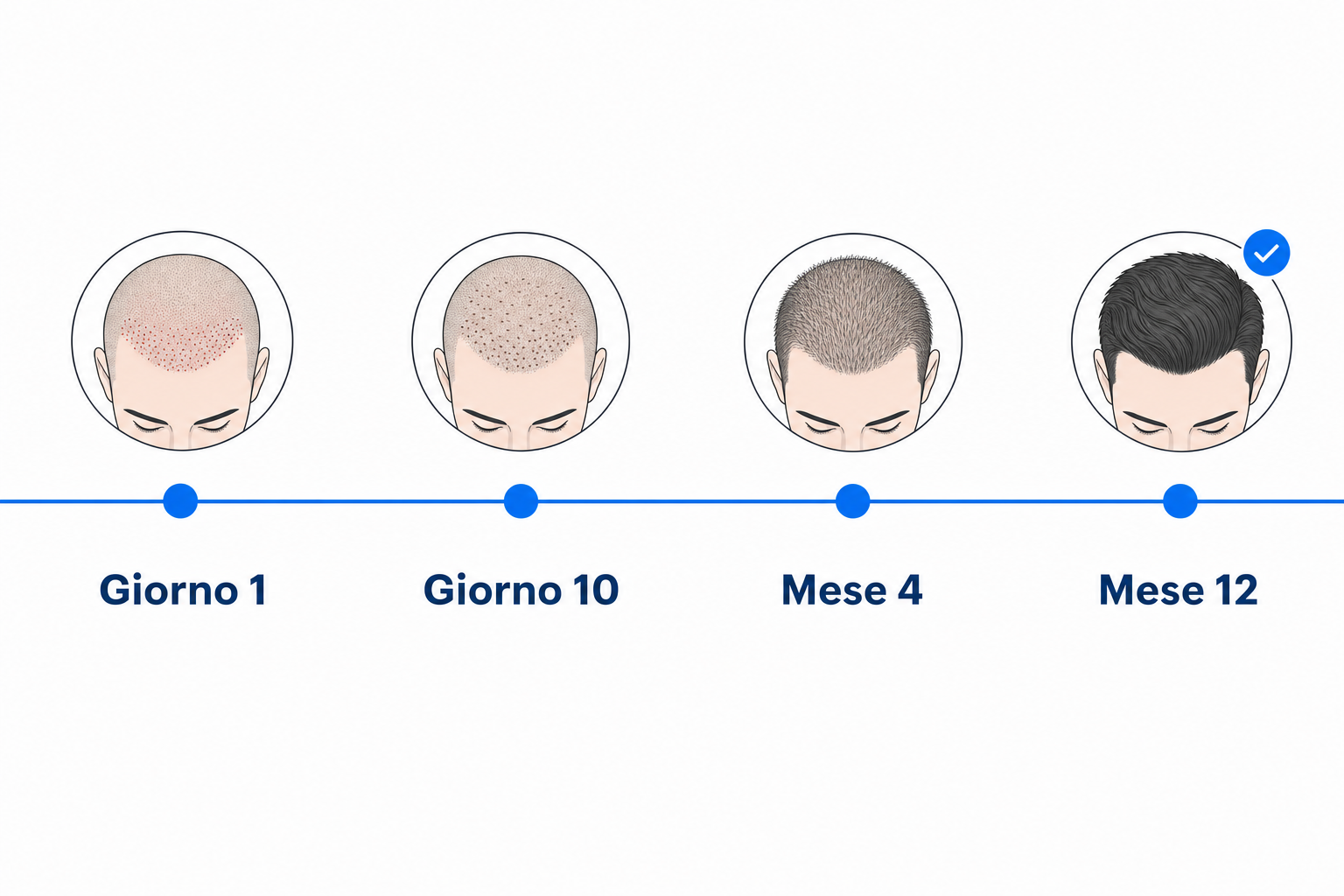 Decorso della guarigione dopo il trapianto di capelli senza rasatura, dal giorno 1 al mese 12