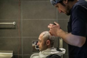 Paziente mostra il suo risultato dopo il trapianto di capelli senza rasatura