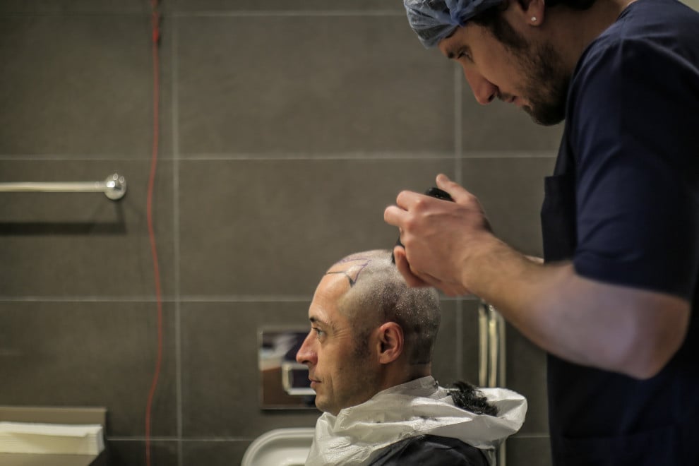 Paziente mostra il suo risultato dopo il trapianto di capelli senza rasatura