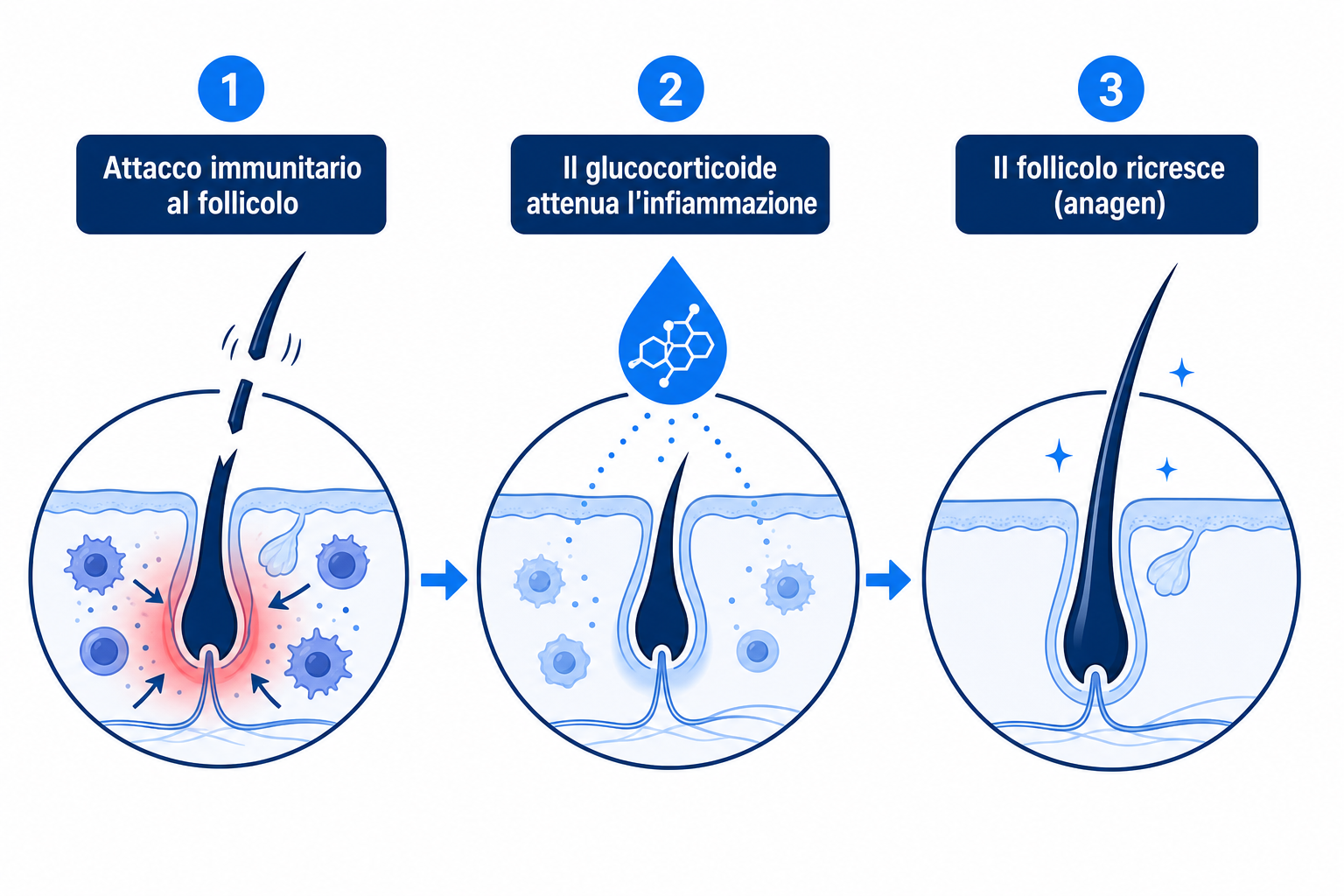 Infografica: come i glucocorticoidi attenuano l'attacco immunitario al follicolo pilifero e rendono possibile la ricrescita