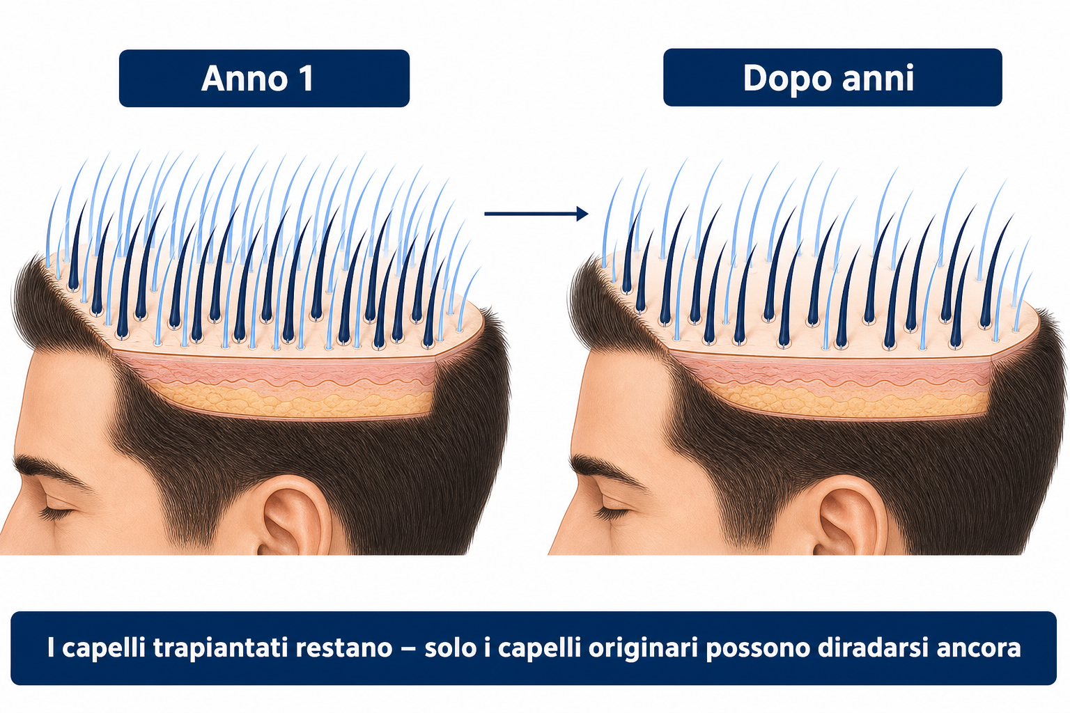 I capelli trapiantati restano in modo permanente, solo i capelli propri tra di essi possono continuare a diradarsi nel corso degli anni