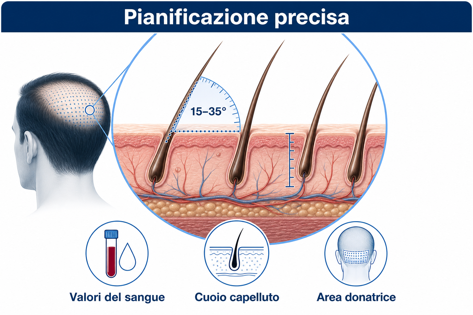 Pianificazione precisa di un trapianto di capelli: angolo di impianto da 15 a 35 gradi, analisi del cuoio capelluto e dell'area donatrice