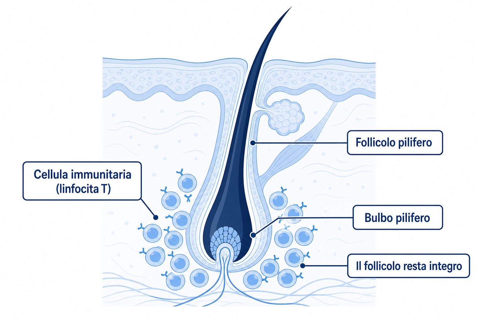 Meccanismo autoimmune nell'alopecia areata: le cellule immunitarie attaccano il bulbo pilifero, il follicolo resta integro