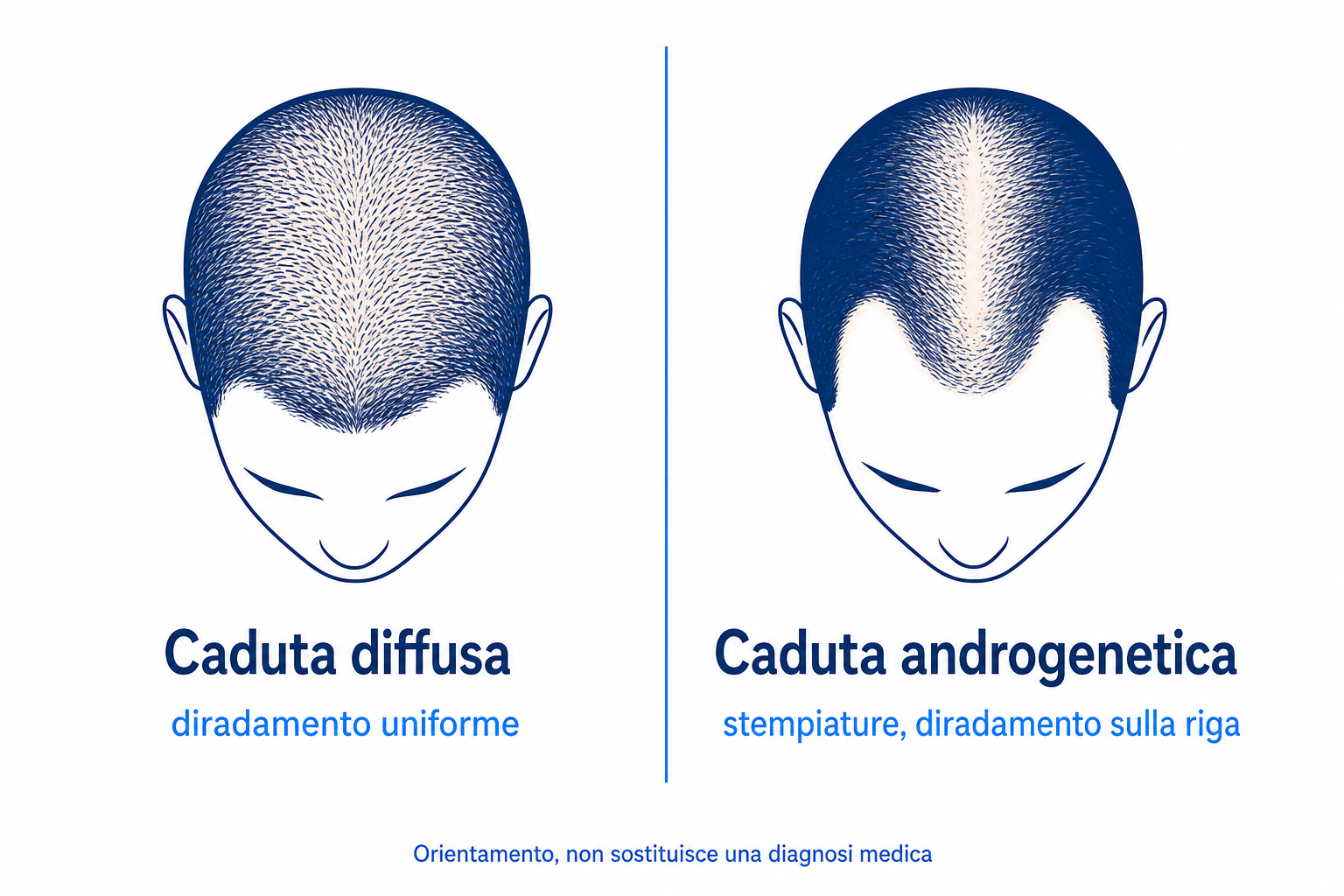 Diagramma di confronto tra caduta diffusa e androgenetica, due sagome di testa con schema di diradamento