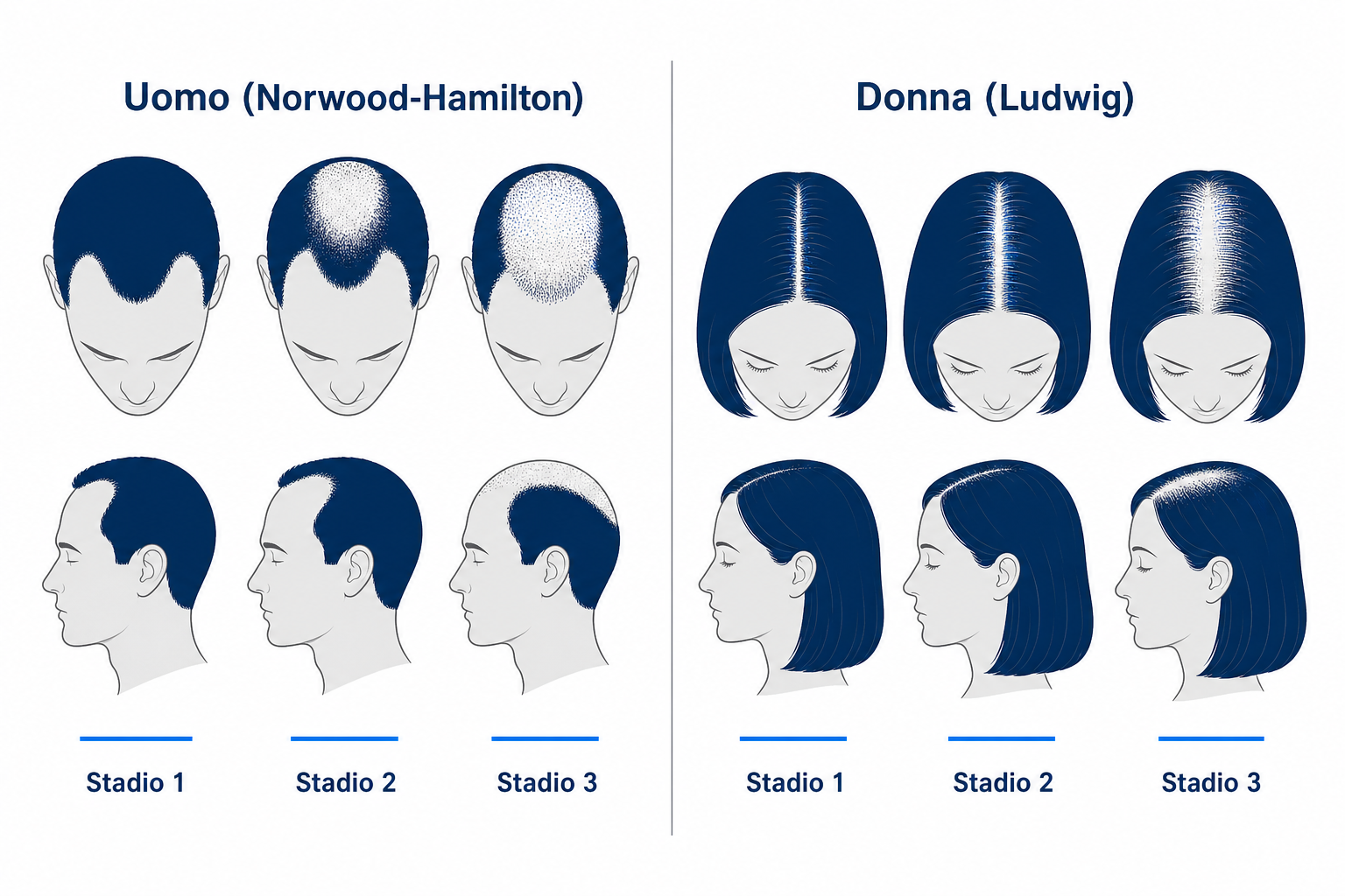 Confronto schematico degli schemi di caduta dei capelli nell'uomo (Norwood-Hamilton) e nella donna (Ludwig) nell'alopecia androgenetica