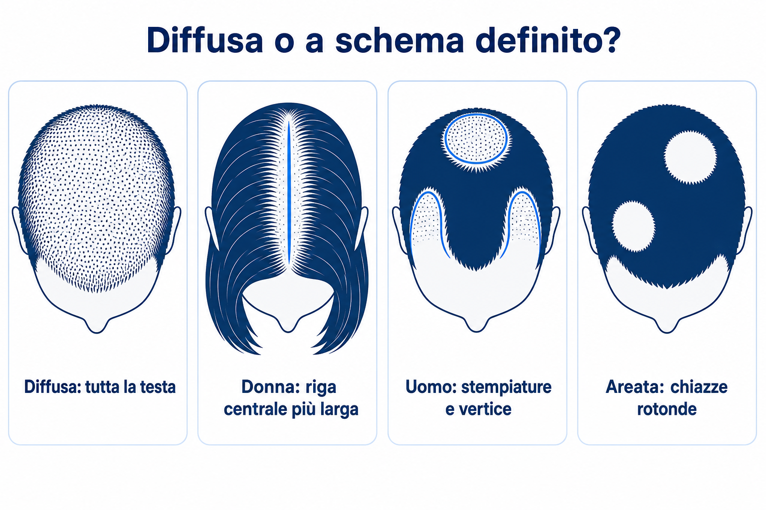 Confronto di quattro schemi di caduta dei capelli: diradamento diffuso su tutta la testa, riga centrale più larga nella donna, stempiature e vertice nell'uomo, chiazze rotonde glabre nell'alopecia areata