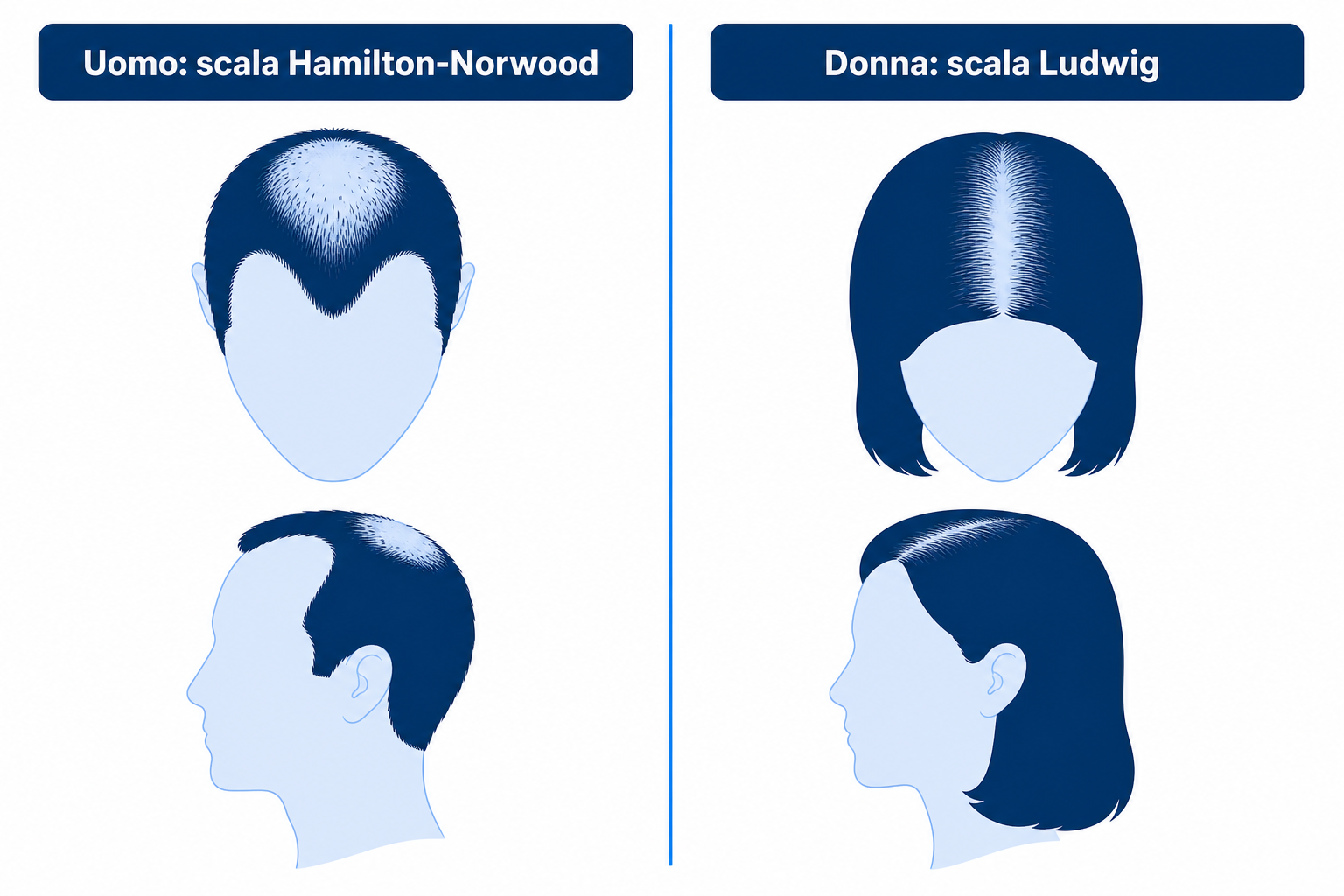 Confronto affiancato degli schemi di caduta androgenetica nell'uomo (scala Hamilton-Norwood) e nella donna (scala Ludwig)