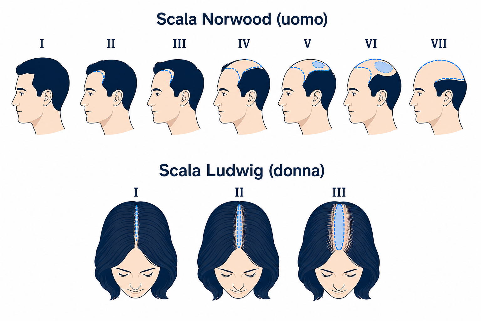 Scala Norwood per gli uomini e scala Ludwig per le donne per inquadrare la caduta a schema