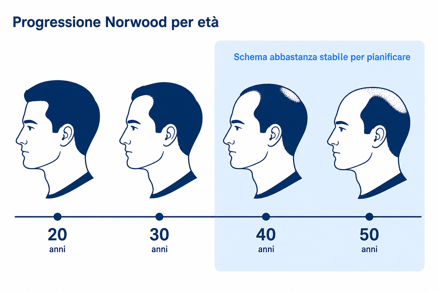 Linea del tempo della progressione Norwood: perdita di capelli che avanza con l'aumentare dell'età