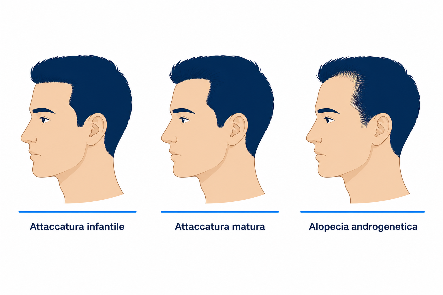 Tre profili di teste a confronto: attaccatura infantile, attaccatura matura e alopecia androgenetica